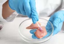 Listeriosi (infezione da listeria)
