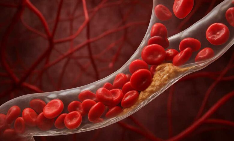 Scoperto come il diabete di tipo 2 danneggia silenziosamente i vasi sanguigni